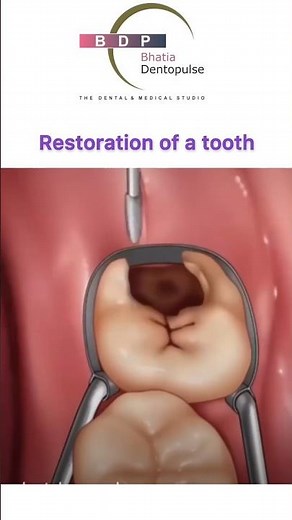 How is tooth cavity removed? #cavity #teeth #dentist