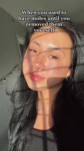 Effective Ways to Remove Moles Safely at Home