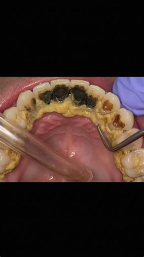 Removing tartar with an ultrasonic scaler