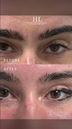 Endoscopic Brow Lift and an Endoscopic Temporal Lift (Cat Eye Lift)