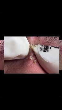 cleaning infected blackhead
