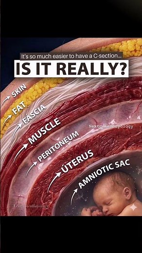 They said a C-section is the ‘easy way out’… IS IT? 😳 #shorts