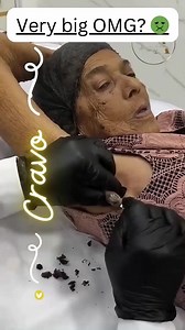 😳 It looked small, but wait till you see the ending! #drpimplepopper #grossaddiction | Pimple Popping