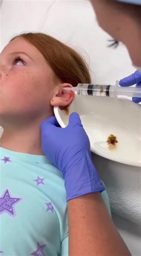 Avoid Casual Ear Cleaning for Kids