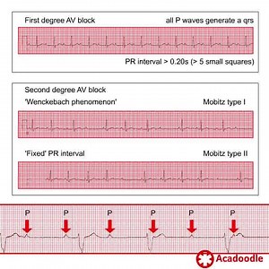 1.6K views · 39 reactions | How to Recognize AV Block - Some Quick Tips - Find out more at https://acadoodle.com #emergencymedicine #intensivecare #respiratory #respiratorycare #icu #nurses #icunurse #ecg #ekg #cme #cmeonline | Acadoodle | Facebook