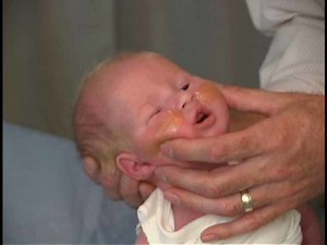 Neurologic Exam-Pediatric | Newborn | Abnormal | Cranial Nerves