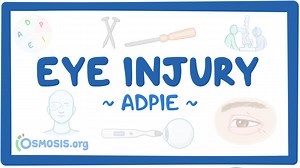 Eye injury: Nursing process (ADPIE): Video, Causes, & Meaning | Osmosis