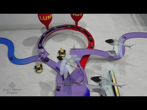 Hypoplastic Left Heart: The Norwood Operation