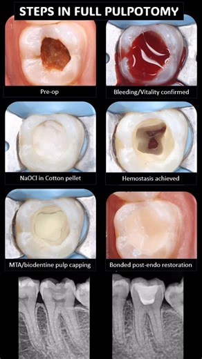 Dr.Tana Prity on Instagram: "Since a lot of you have sent dms asking about the bleeding time in Pulpotomy….so here is a post for you all ✨ p.s:- I follow the AAE recommendations of upto 10 mins since many other studies reported subsequent reduction in success rates with increase in time taken to achieve hemostasis during VPT #vital #vitalpulptherapy #bleeding #dentistry #pulpotomy #time #tooth #oralhealth #lifelately #dental #dentistrytoday #dentist #endodontist #oralhealthmatters"