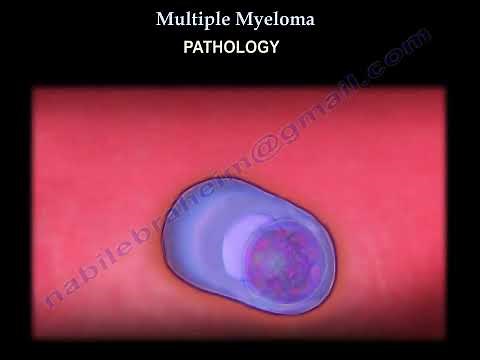 Multiple Myeloma Symptoms, Diagnosis, and Treatment
