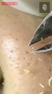 Giant Blackhead Extraction ASMR - Dramatic Pore Cleansing