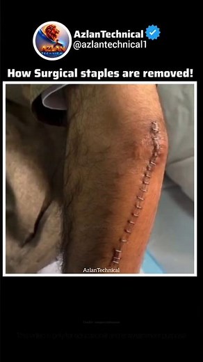 How Surgical Staples Are Removed #science #surgeon #medical #medtech #doctor