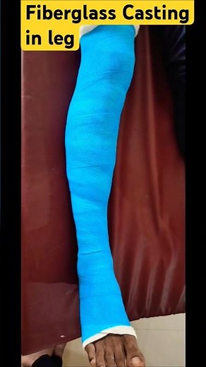 Fiberglass Casting in Leg #Tibia fracture#leg injury #Cast #orthopaedic #hospital #bonefracture#bone