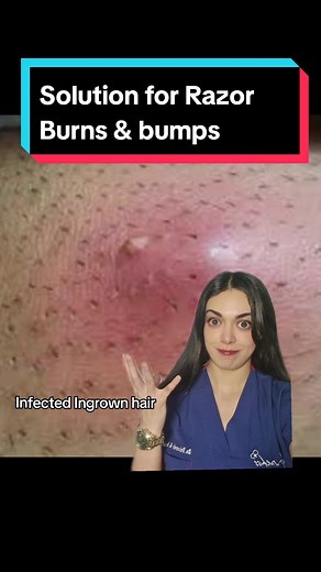 We've all been there - that sting after shaving, which sometimes turns into something more painful infection that is less easy to ignore. But fear not, because I have the solution for you! Thyme and Tea Tree Infection Salve is specially formulated to soothe your skin and prevent any post-shave irritations from turning into infections. This salve will leave your skin feeling smooth, healthy, and irritation-free. Say goodbye to those painful post-shave problems once and for all! 🌿👌 #SkincareSolu