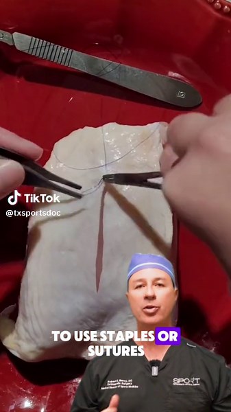 Stitches vs. Staples: Closing the Deal in Orthopaedic Surgery Both sutures (stitches) and staples get the job done when it comes to closing surgical wounds in orthopedics, but they each have their own pros and cons! Sutures offer precise control, allowing surgeons to create a tailored closure that adapts to different tissues. They may also be less likely to cause infection in some cases. However, suturing can be time-consuming. Staples are much faster to apply, which can be beneficial for longer