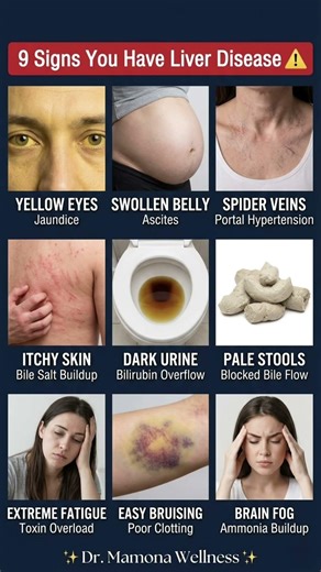 9 Warning Signs Your Liver Is Failing 🚨 Don’t Ignore #medicalfacts #healthtips #healthwarning