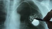 Doctor Examining X-Ray Image of Chest with Artificial Cardiac...