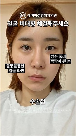Facial Asymmetry Improvement, Facial Contouring + Eye Revision Surgery Review #shorts