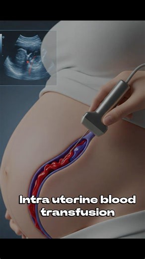 Intrauterine Blood Transfusion | Life saving procedure #fetalmedicine #obstetrics #iut