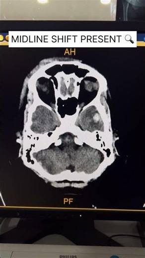 Extradural Hematoma with Temporal Contusions #shorts