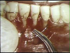 888 Laterally Positioned Flap in Periodontics Pedicle Graft