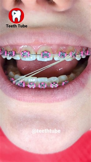 InterArch Elastic for Midline Correction