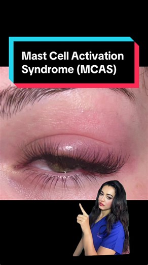 Understanding Mast Cell Activation Syndrome and Its Symptoms