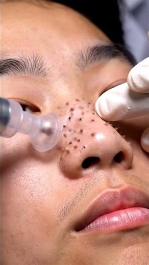 Satisfying ASMR Deep Cleanse: Blackhead Removal on Lower Chin Curve #asmr #shortvideo #satisfying