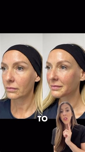 Multi Award Winning Aesthetic Wellness Clinics 🥇 on Instagram: "Full Facial Harmonisation at Dr Yusra Clinic ✨ Dermal filler often gets a bad reputation but when used correctly, it remains one of the most powerful tools in medical aesthetics. At Dr Yusra Clinic, filler is never about overfilling or trends. It’s about facial anatomy, proportions, and how the face ages over time. Through a full facial approach, we restore structural support, rebalance facial ratios, and enhance harmony not indivi