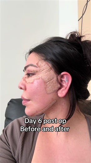 Day 6 Post Op Facelift Recovery Insights