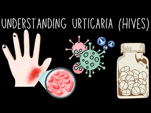 Urticaria (Hives) - Everything You Need To Know