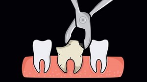 Download Tooth Extraction Dental Medical Animation On Alpha Channel for free