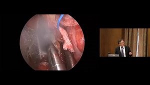 Endoscopic Transorbital Approaches to the Skull Base: The Basics