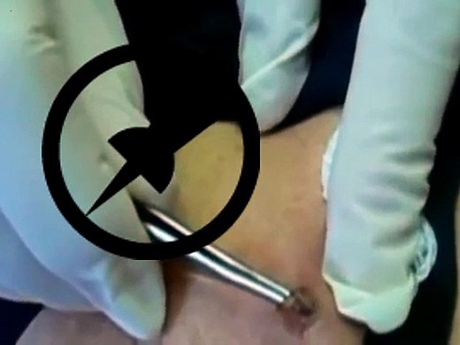 The biggest human botfly compilation ever! Top 10!1