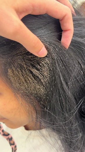 Effective Lice Removal Techniques Revealed