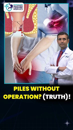 Can Piles Be Cured Without Surgery? Doctors Reveal The Truth!