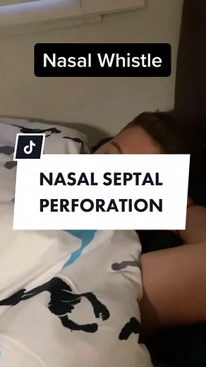 Understanding Nasal Septal Perforation in Plasticsurgery