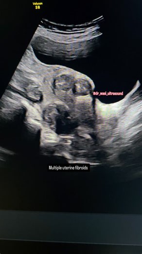 Dr wasi on Instagram: "Multiple uterine fibroids #fibroids #ultrasonography #medicaleducation #abdominalultrasound #ultrasoundmadeeasy #gynaecology #gynaecologicalultrasound"