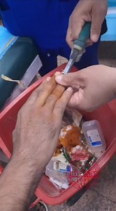 Removal of finger fixation plate under local anesthesia