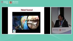 Double Bundle PCL Reconstruction