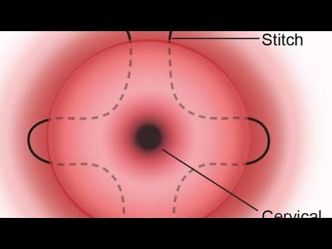 Cervical Cerclage - Indications and Types