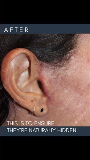 Deep Plane Face Lift + Deep Plane Neck Lift - 2.5 Month Check In