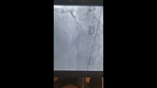 After a three-year interruption, the Cardiac Catheterization Lab at Ayder Comprehensive Specialized Hospital, Mekelle University, has been fully reinstated to operational status. The cardiologist team successfully conducted the first diagnostic angiography on a 67-year-old male patient. This achievement underscores the dedication of the college and hospital staff. With the lab back in action, patients can now receive timely and comprehensive care for heart conditions. # WeReallyCare #BuildBackBe