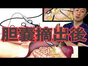 胆嚢摘出術後の悩み解決