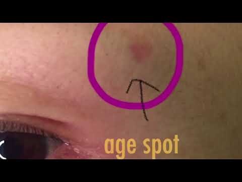 Mole Removal Pen Part 2