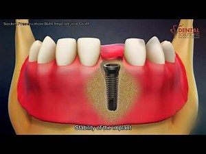Tooth Socket preservation using bone grafting after tooth extraction
