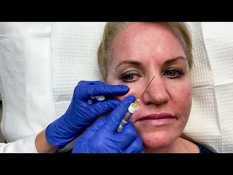 Mid-Face Filler with Dr. Sarhaddi