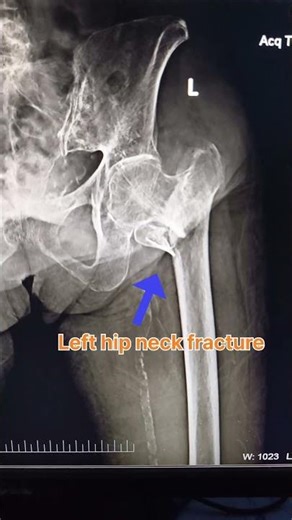 Hip bone fracture | video no 41