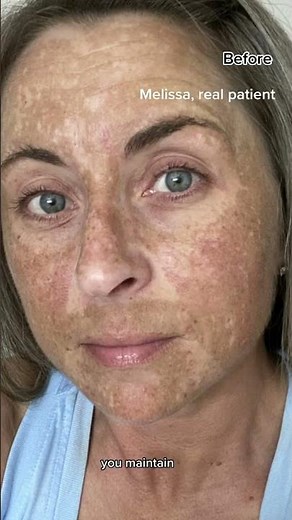 Melasma Can Be Cured With Hydroquinone: Dermatologist Explains!