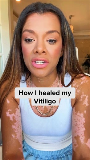 I spent years trying to cover my vitiligo. Makeup, camouflage products, special routines, even clinical treatments. It would look better for a while. Then the contrast would show again. New patches appeared where I didn’t expect them — around my mouth, my eyes, my hands. I started to believe the lie — that this was just something I had to live with. But then I watched Dr. Turner — a well-known dermatologist — explain something I’d never heard before: 👉 That vitiligo has very little to do with s
